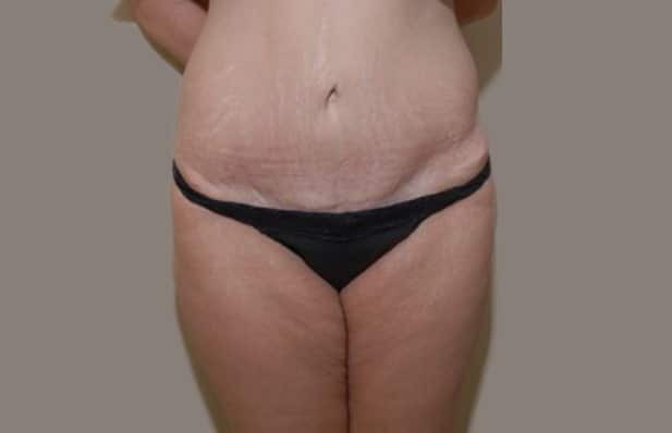 aprés abdominoplastie Tunisie