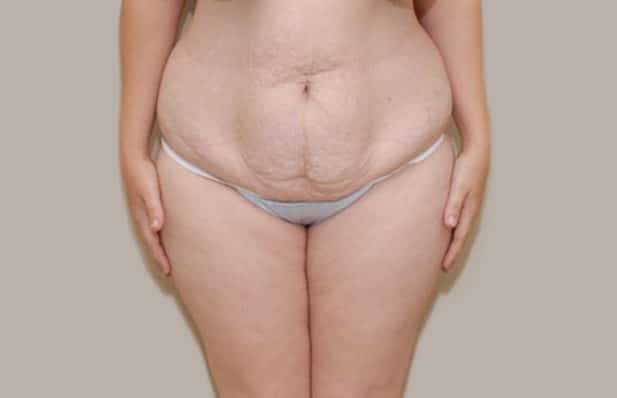 avant abdominoplastie Tunisie