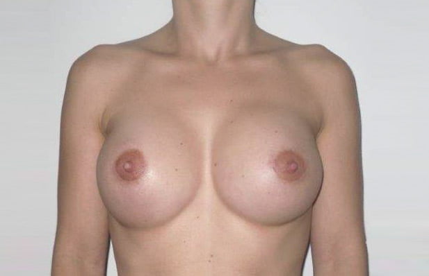 résultat après augmentation mammaire