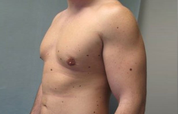 gynecomastie avant et aprés