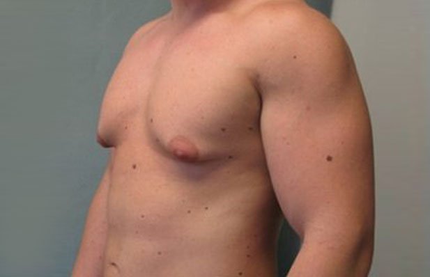 gynecomastie avant et aprés