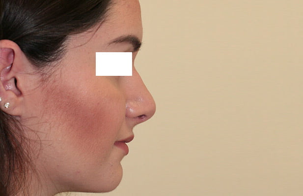 resultat aprés rhinoplastie