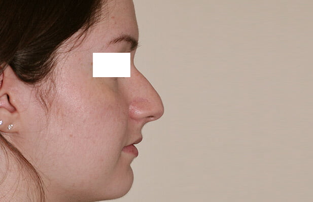 rhinoplastie avant