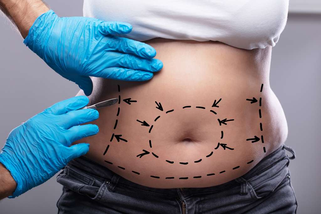 Chirurgie bariatrique Tunisie