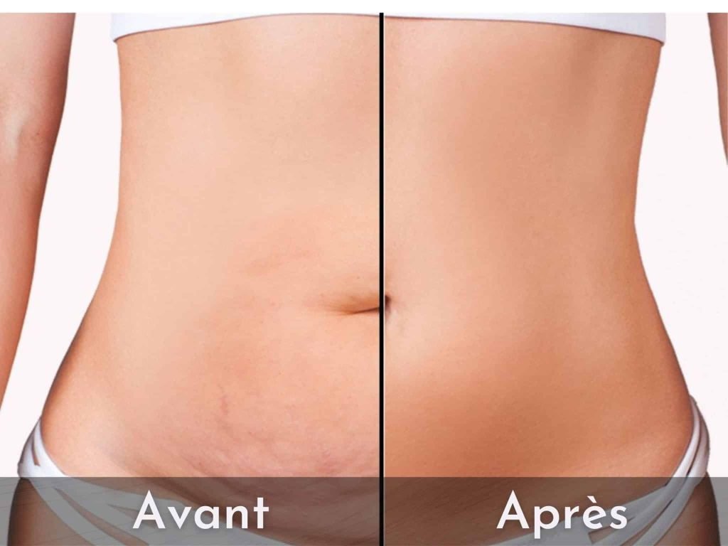 avant après abdominoplastie