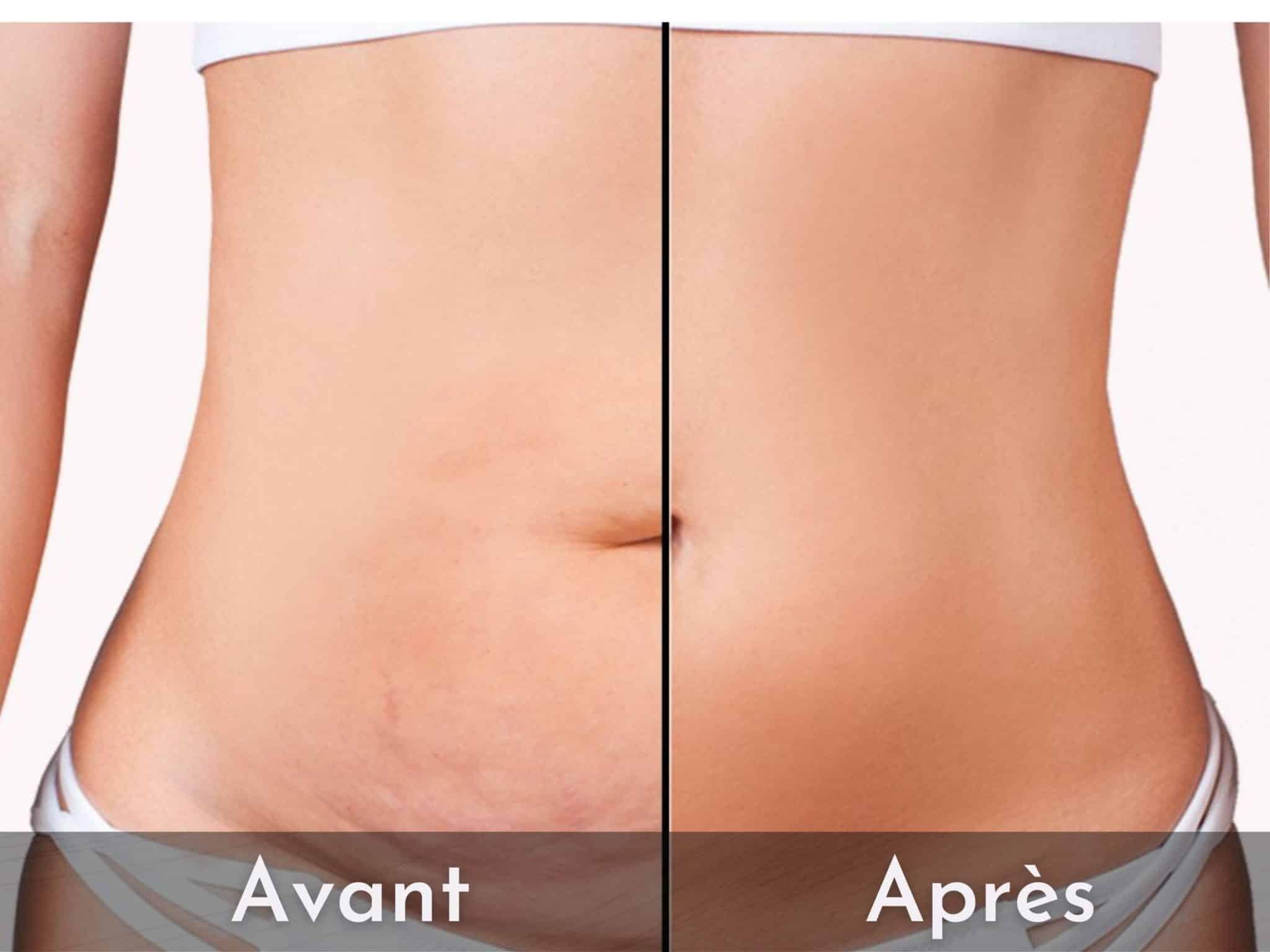 Abdominoplastie en Tunisie : comment éviter le gonflement après une plastie abdominale ?