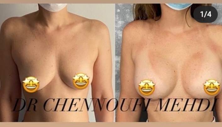 Augmentation mammaire Tunisie avant et aprés