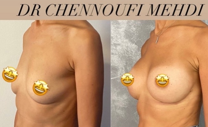 chirurgie mammaire Tunisie avant et après