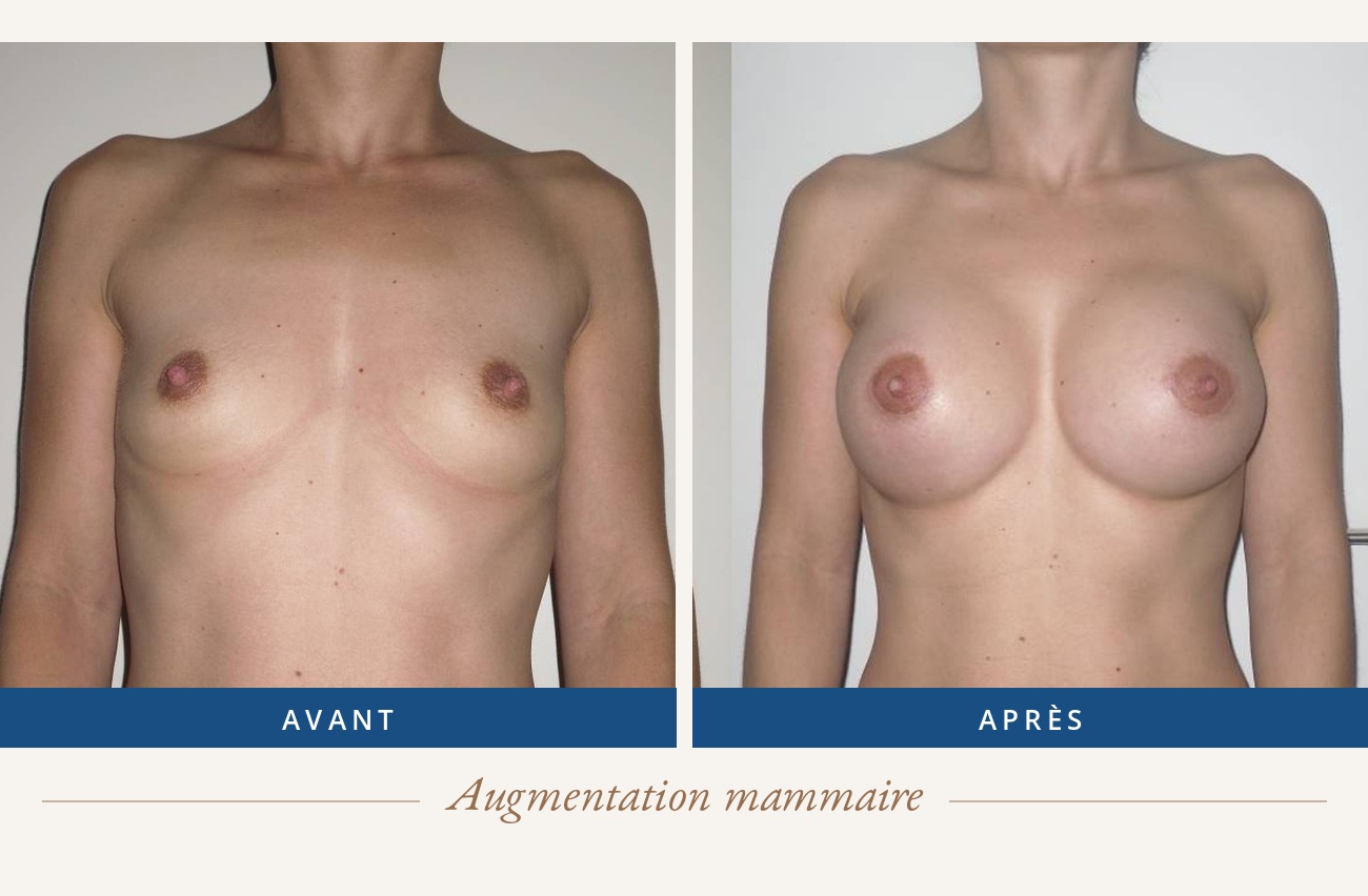 Résultat avant/après d'une augmentation mammaire