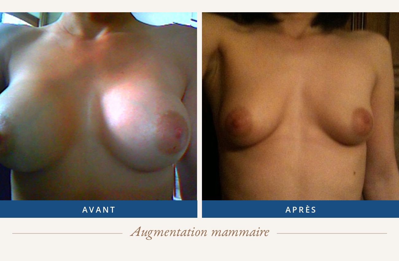 Résultat avant/après d'une augmentation mammaire