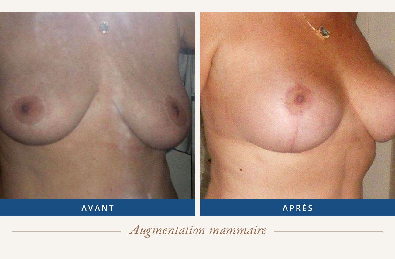 Résultat avant/après d'une augmentation mammaire