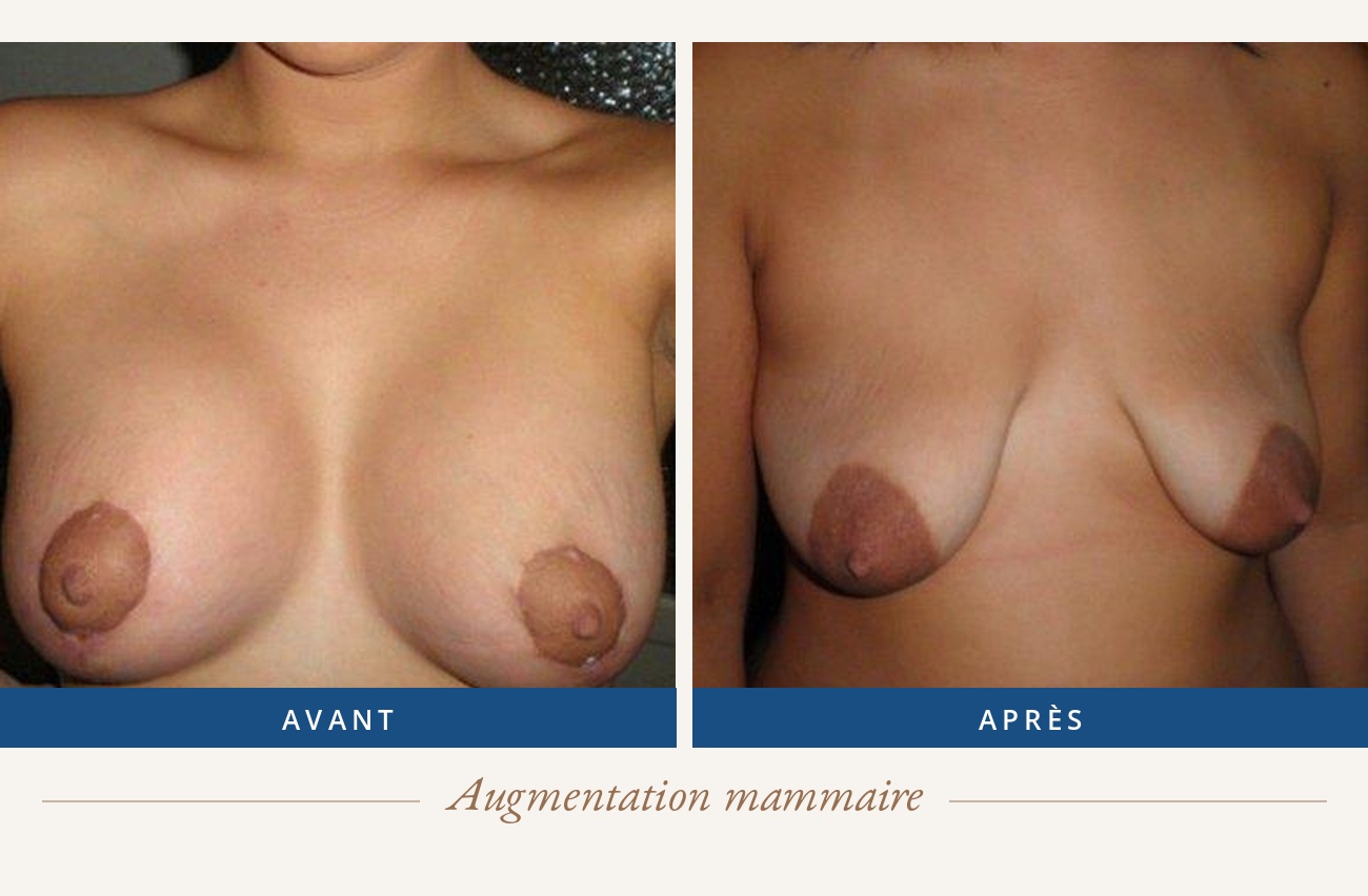 Résultat avant/après d'une augmentation mammaire