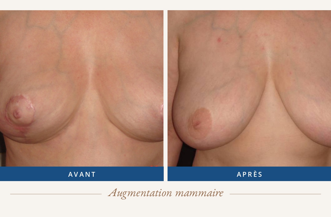 Résultat avant/après d'une augmentation mammaire
