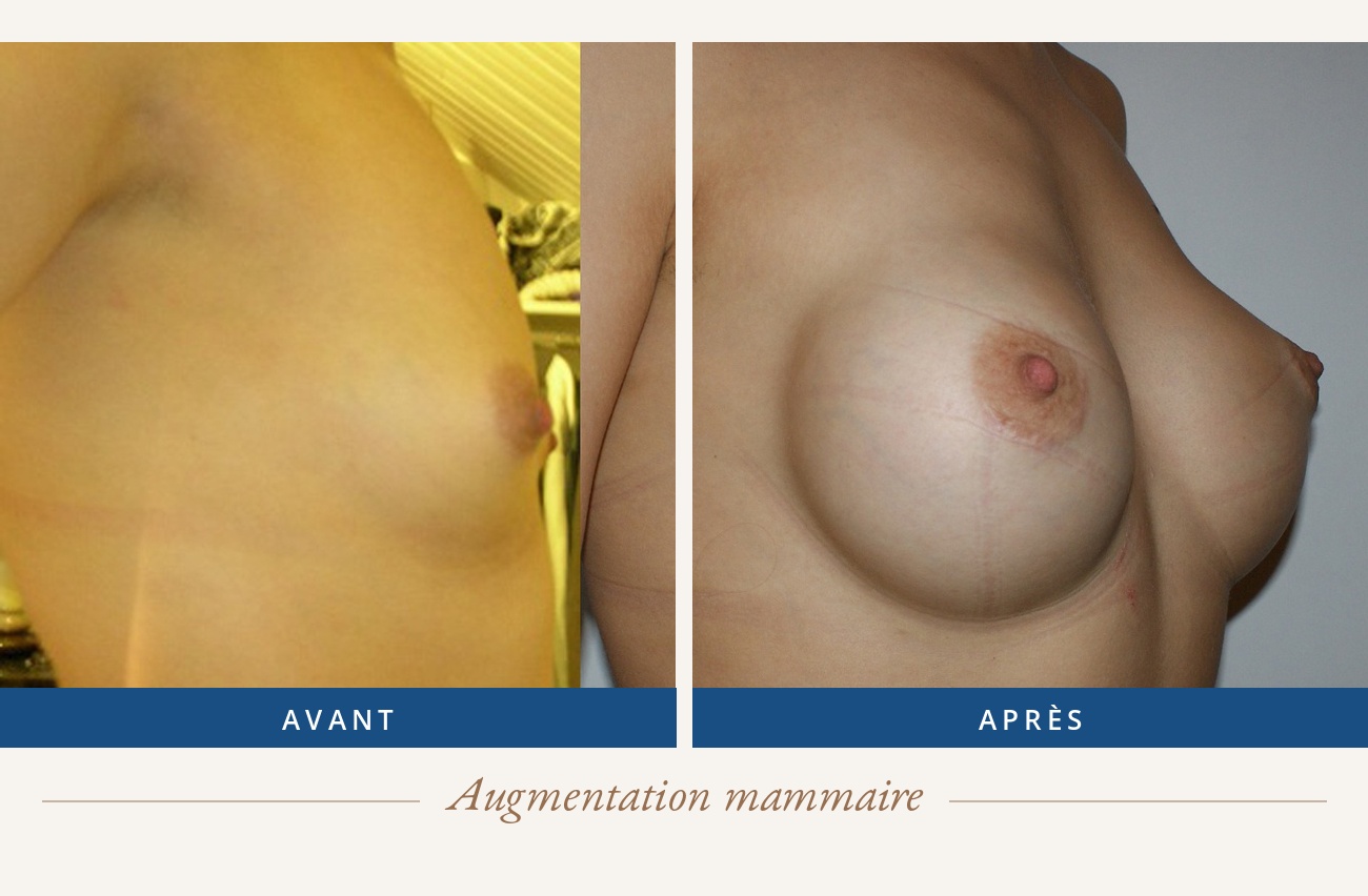 Résultat avant/après d'une augmentation mammaire