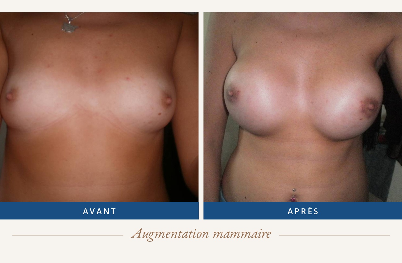 Résultat avant/après d'une augmentation mammaire
