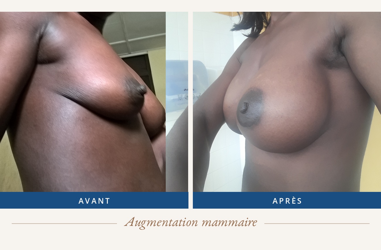 Résultat avant/après d'une augmentation mammaire