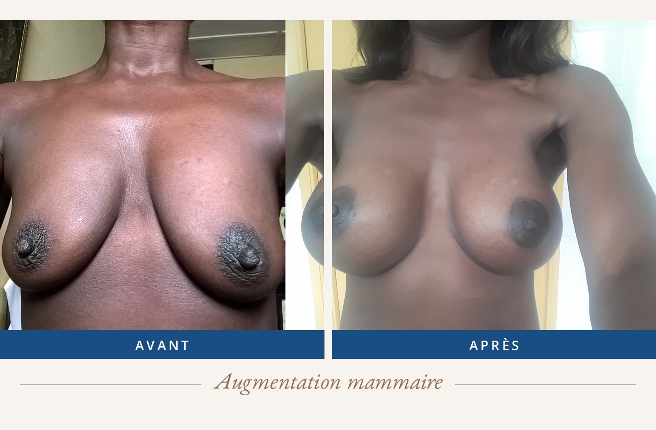 Résultat avant/après d'une augmentation mammaire
