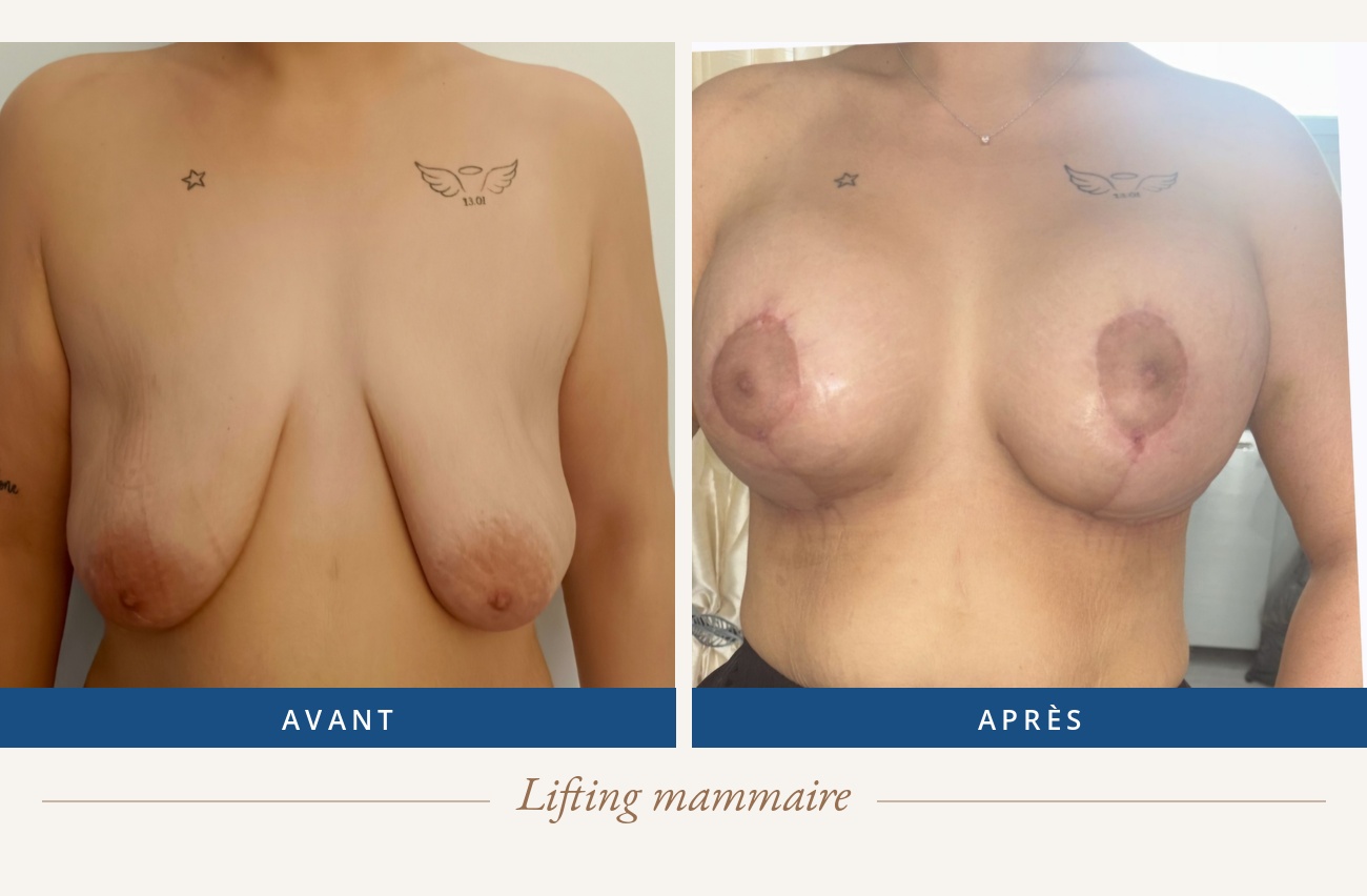 Résultat avant/après d'un lifting mammaire