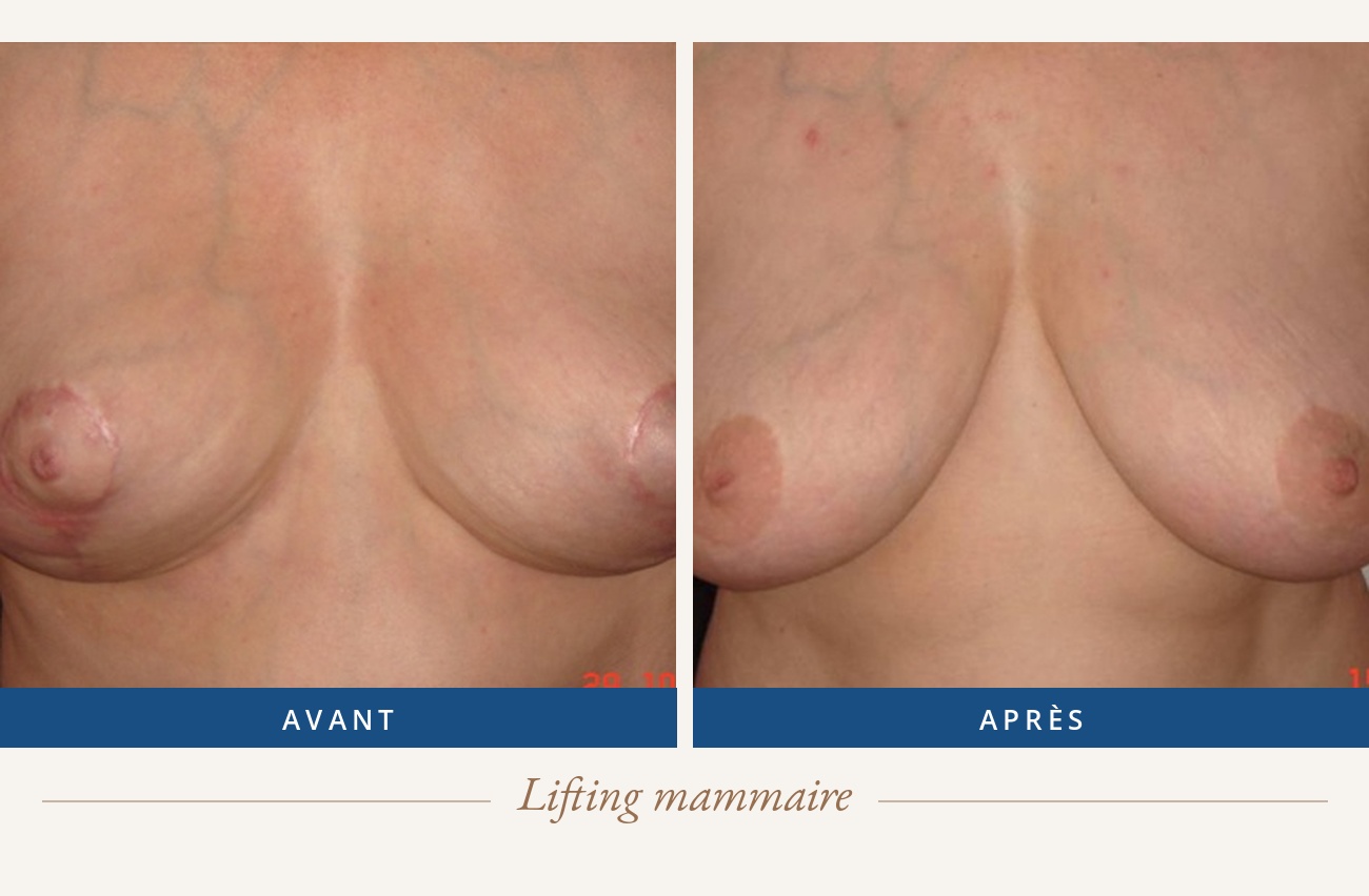 Résultat avant/après d'un lifting mammaire