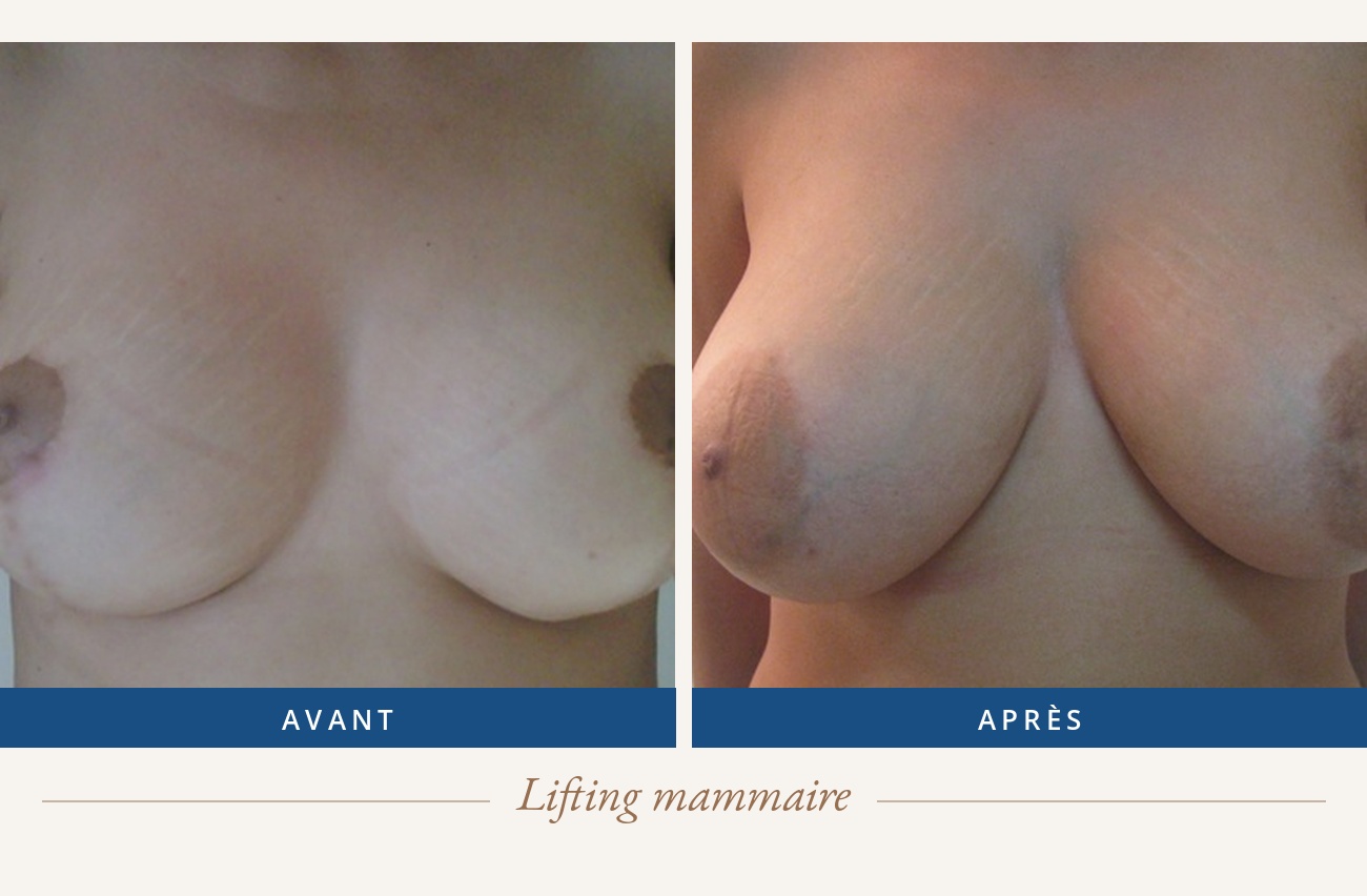 Résultat avant/après d'un lifting mammaire