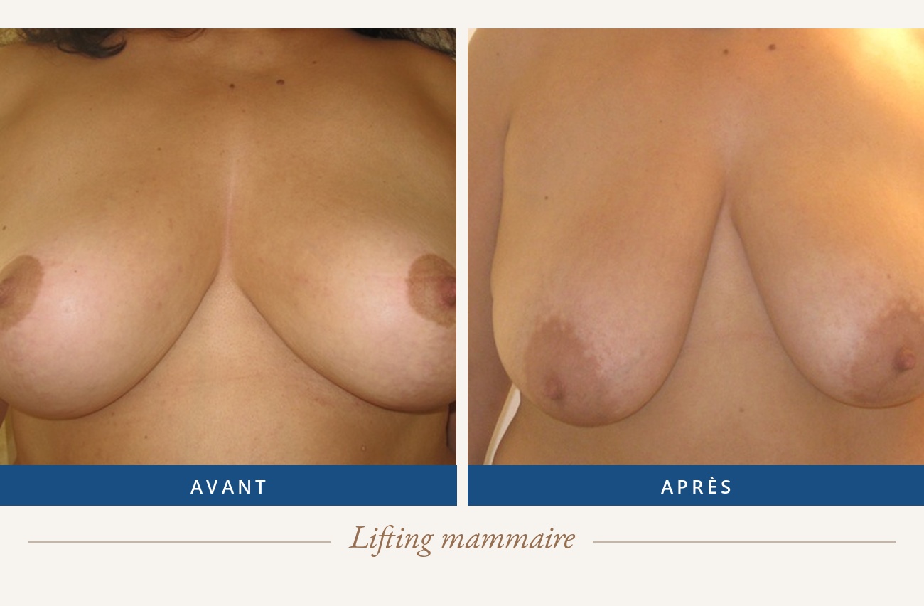 Résultat avant/après d'un lifting mammaire
