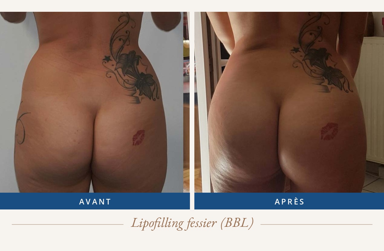 Résultat avant/après d'un lipofilling fessier