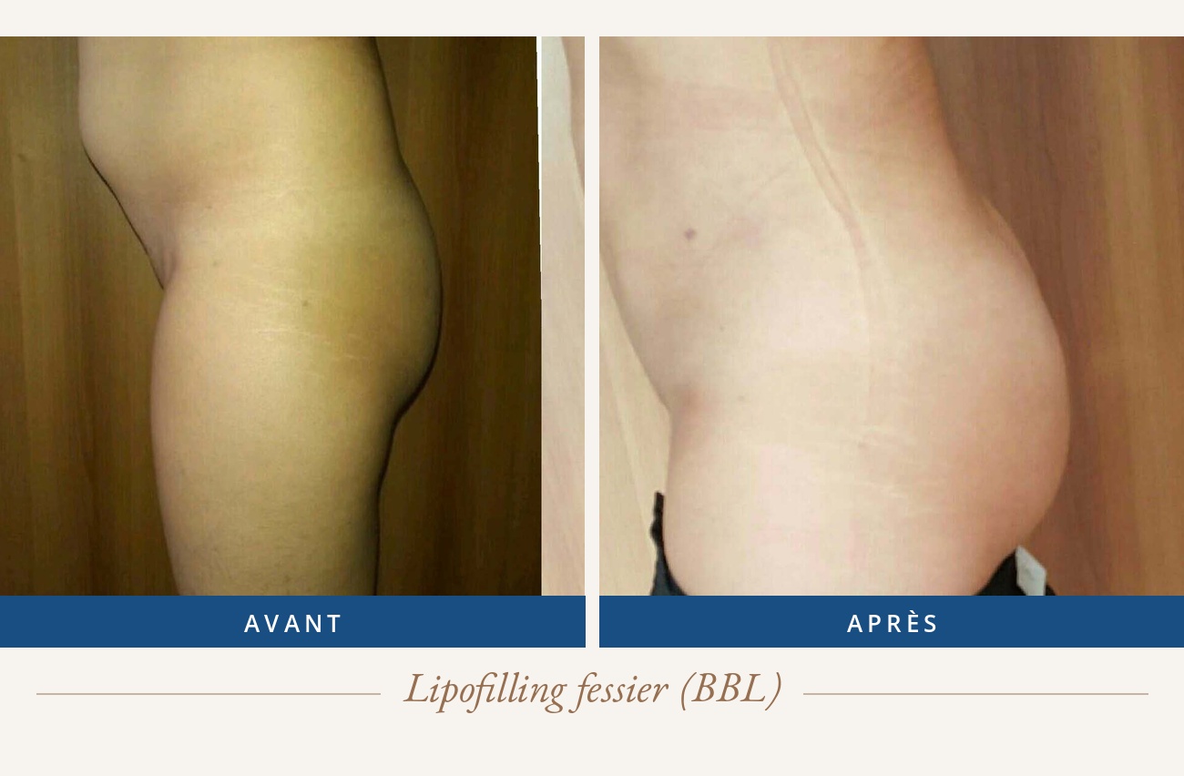 Résultat avant/après d'un lipofilling fessier