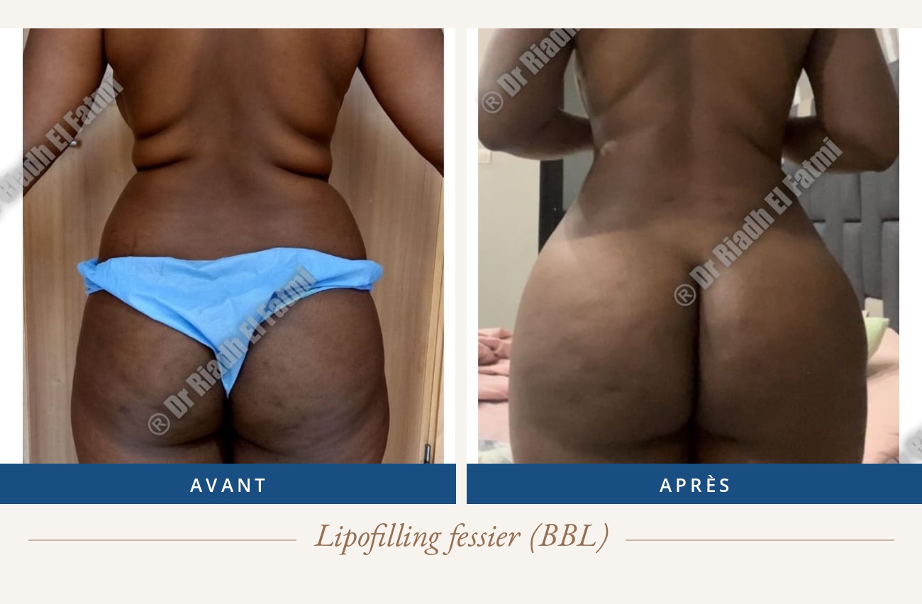 Résultat avant/après d'un lipofilling fessier réalisé par le Dr Riadh El Fatmi, chirurgien partenaire
