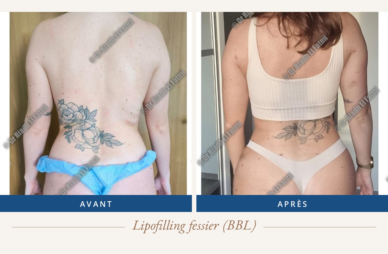 Résultat avant/après d'un lipofilling fessier réalisé par le Dr Riadh El Fatmi, chirurgien partenaire
