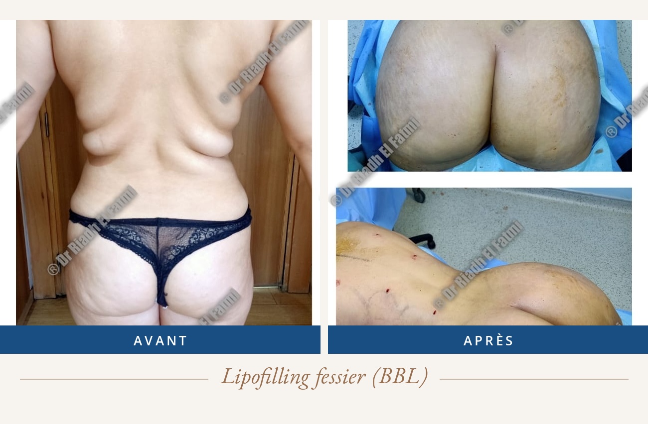 Résultat avant/après d'un lipofilling fessier réalisé par le Dr Riadh El Fatmi, chirurgien partenaire