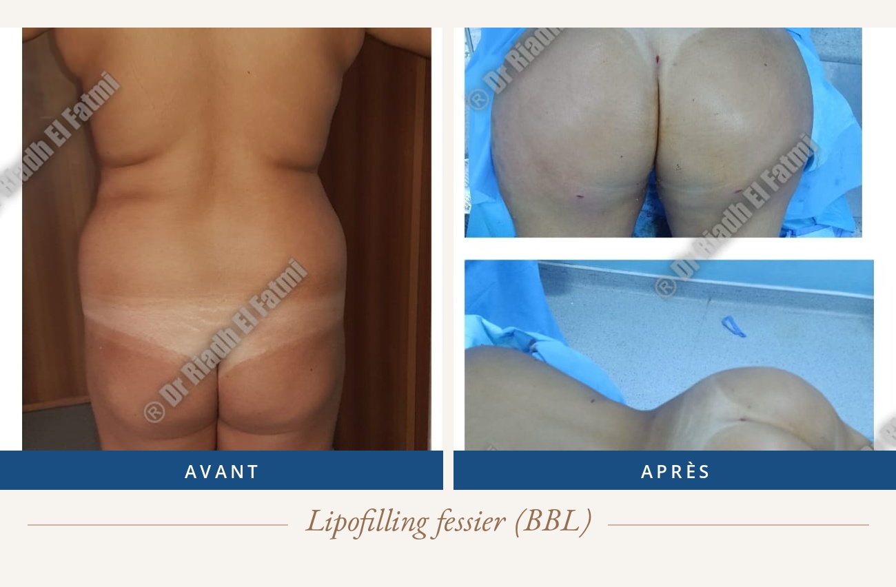 Résultat avant/après d'un lipofilling fessier réalisé par le Dr Riadh El Fatmi, chirurgien partenaire