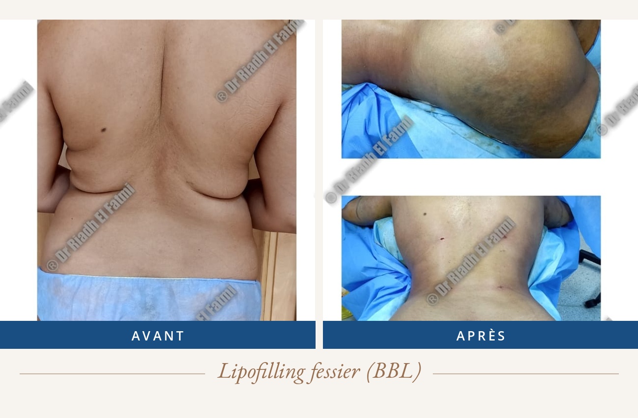 Résultat avant/après d'un lipofilling fessier réalisé par le Dr Riadh El Fatmi, chirurgien partenaire