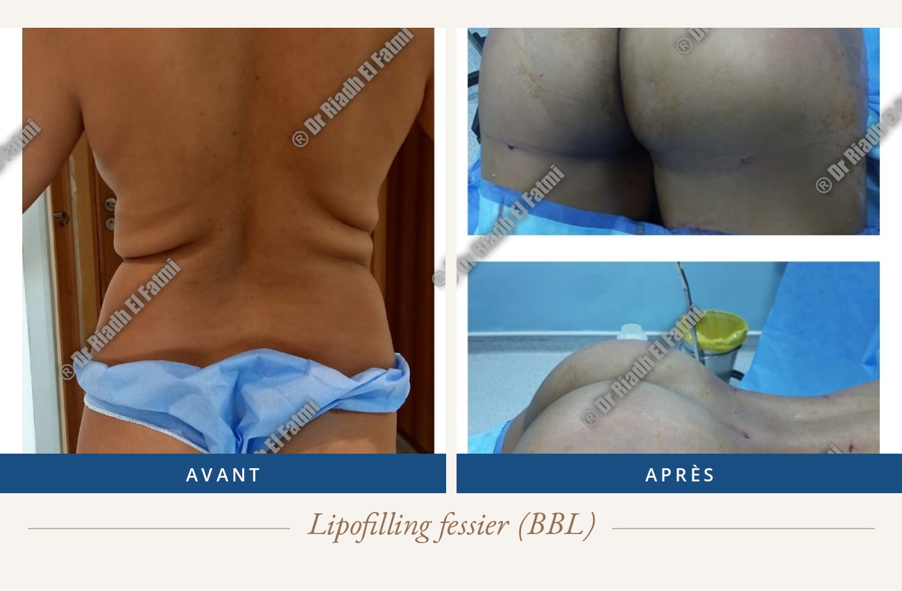 Résultat avant/après d'un lipofilling fessier réalisé par le Dr Riadh El Fatmi, chirurgien partenaire