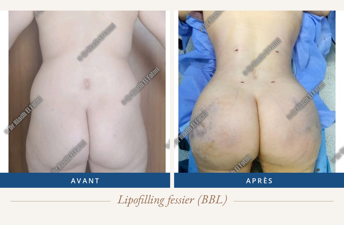 Résultat avant/après d'un lipofilling fessier réalisé par le Dr Riadh El Fatmi, chirurgien partenaire