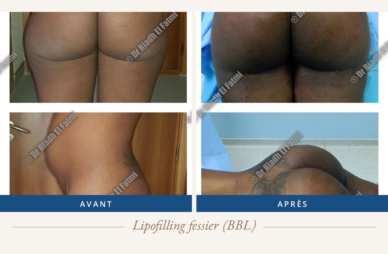 Résultat avant/après d'un lipofilling fessier réalisé par le Dr Riadh El Fatmi, chirurgien partenaire