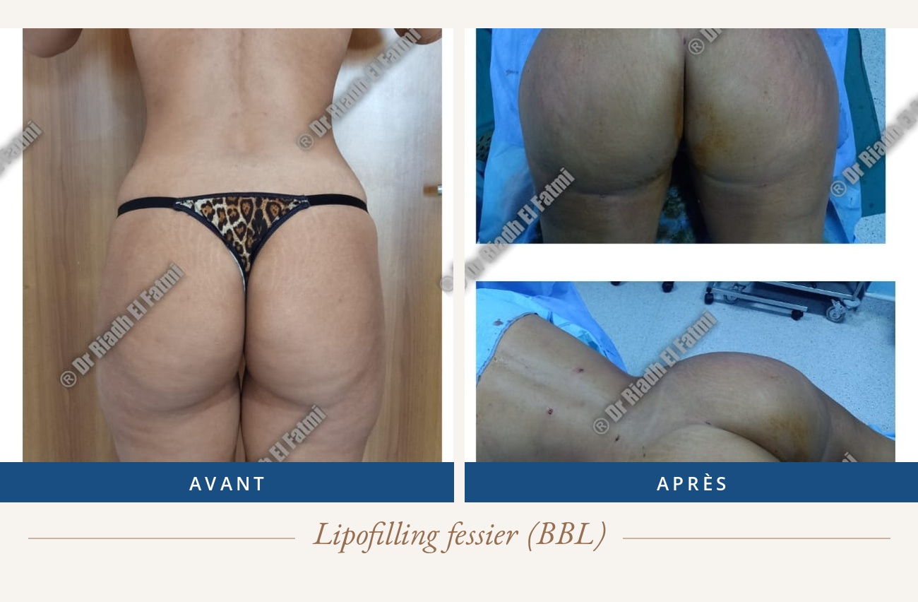 Résultat avant/après d'un lipofilling fessier réalisé par le Dr Riadh El Fatmi, chirurgien partenaire