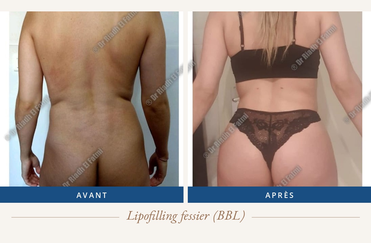 Résultat avant/après d'un lipofilling fessier réalisé par le Dr Riadh El Fatmi, chirurgien partenaire