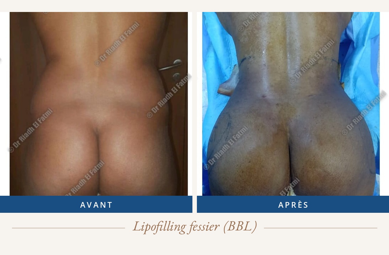 Résultat avant/après d'un lipofilling fessier réalisé par le Dr Riadh El Fatmi, chirurgien partenaire