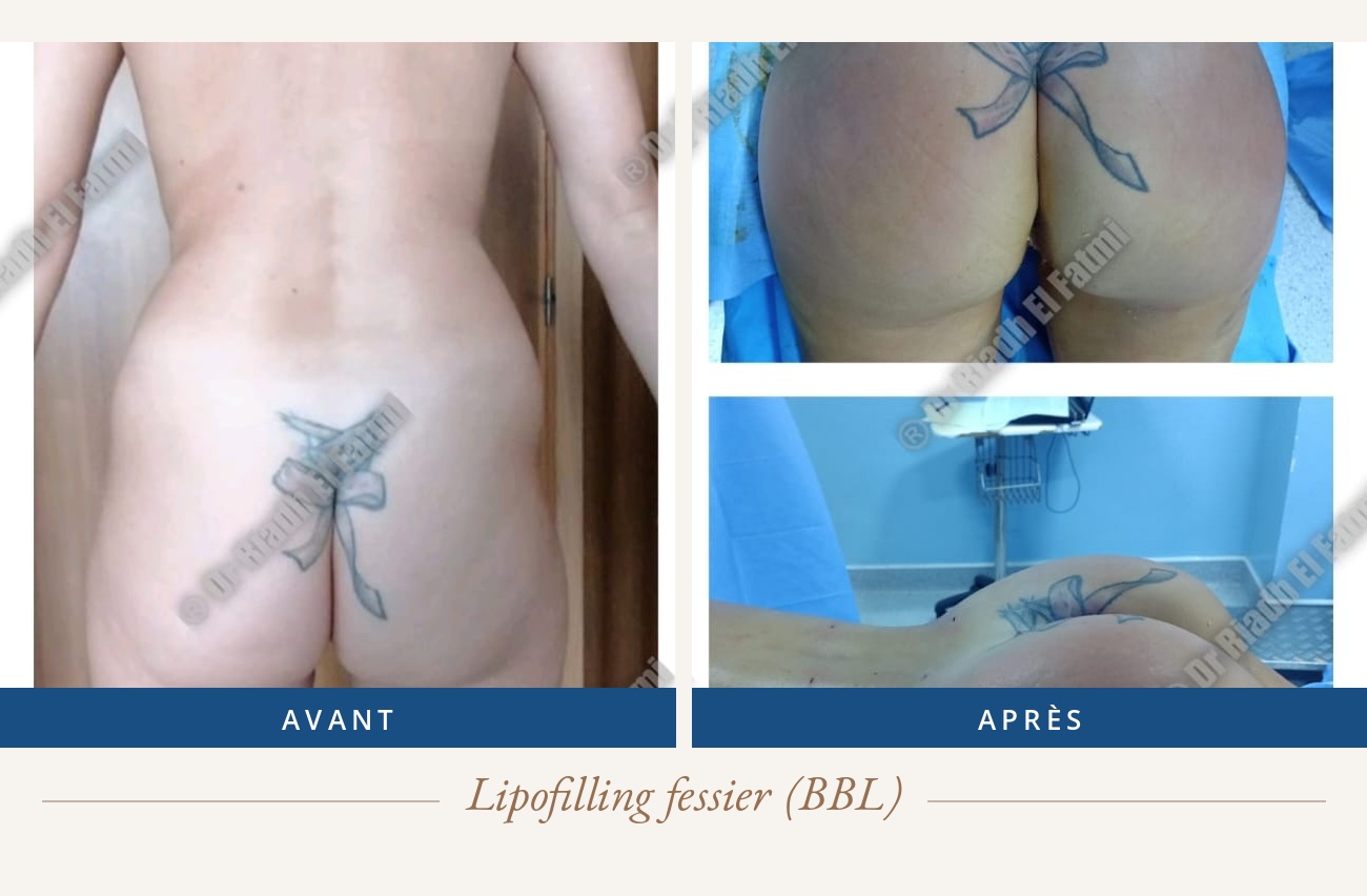 Résultat avant/après d'un lipofilling fessier réalisé par le Dr Riadh El Fatmi, chirurgien partenaire