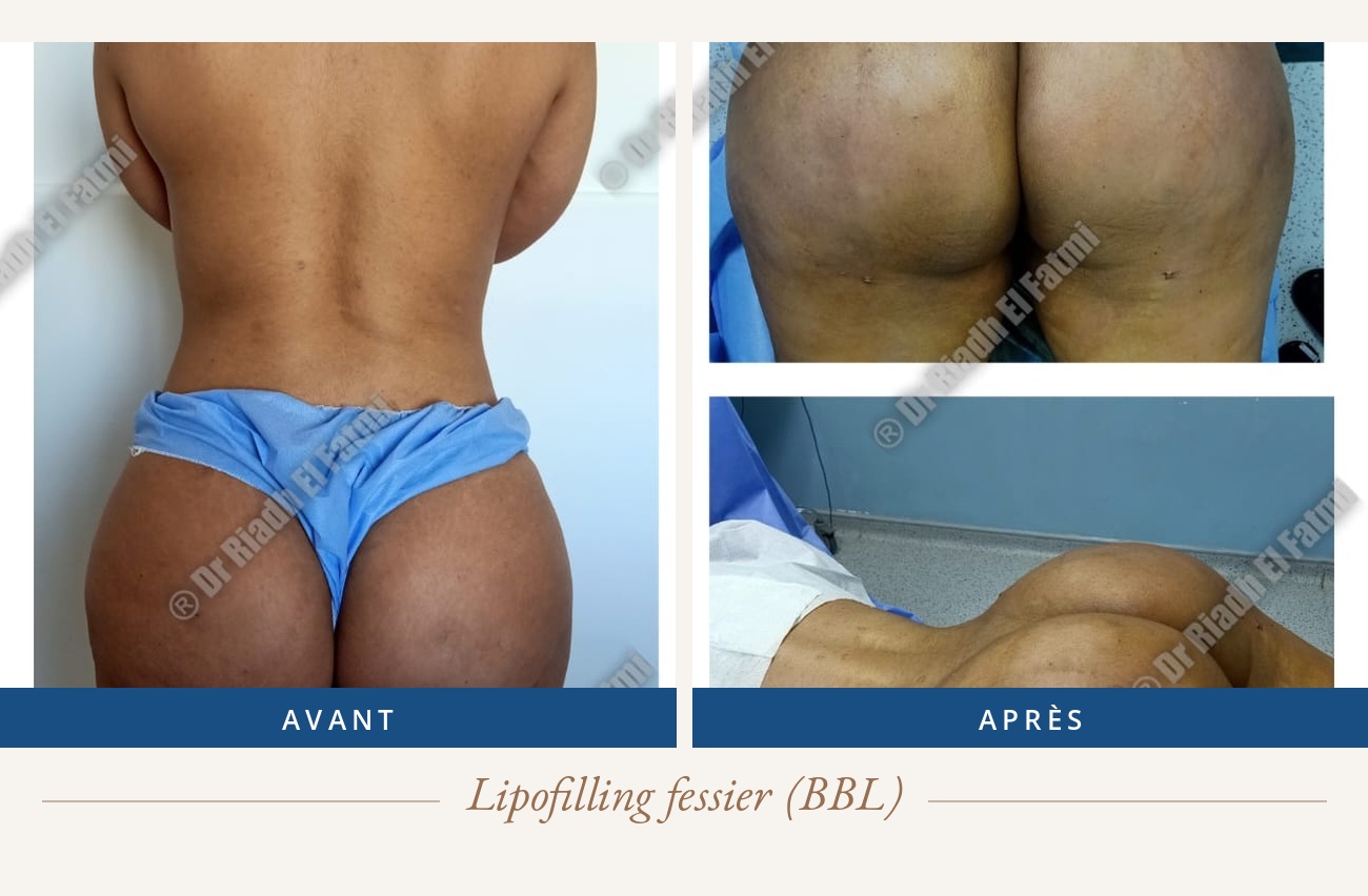 Résultat avant/après d'un lipofilling fessier réalisé par le Dr Riadh El Fatmi, chirurgien partenaire