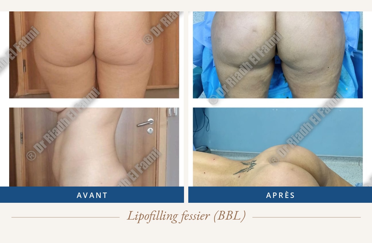 Résultat avant/après d'un lipofilling fessier réalisé par le Dr Riadh El Fatmi, chirurgien partenaire