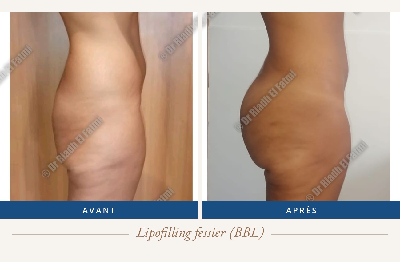 Résultat avant/après d'un lipofilling fessier réalisé par le Dr Riadh El Fatmi, chirurgien partenaire