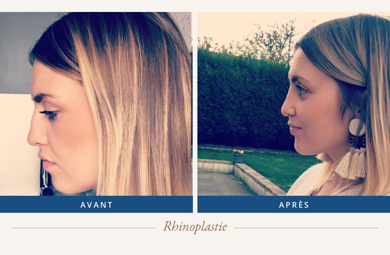 Résultat avant/après d'une rhinoplastie
