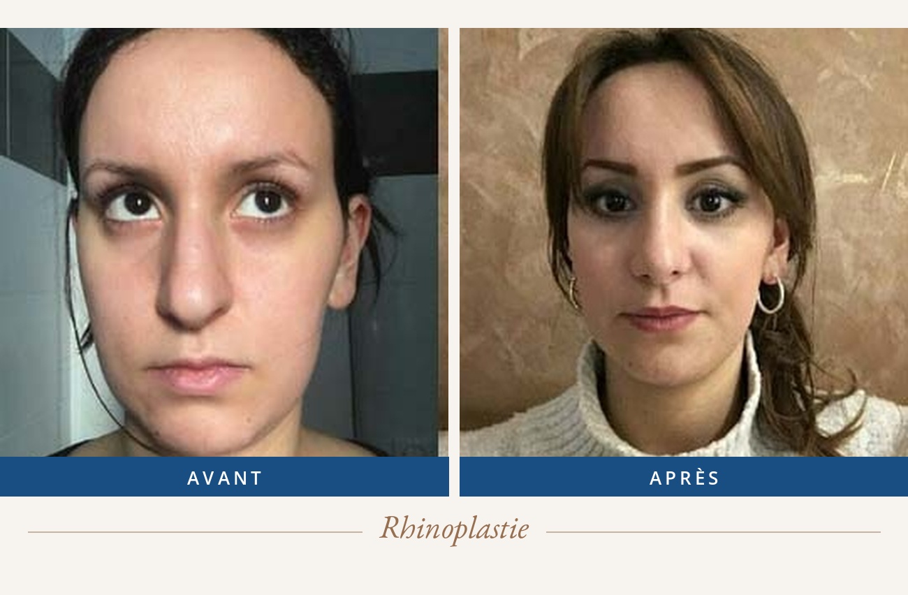 Résultat avant/après d'une rhinoplastie