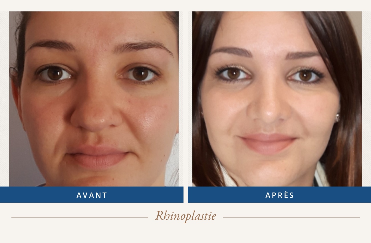 Résultat avant/après d'une rhinoplastie