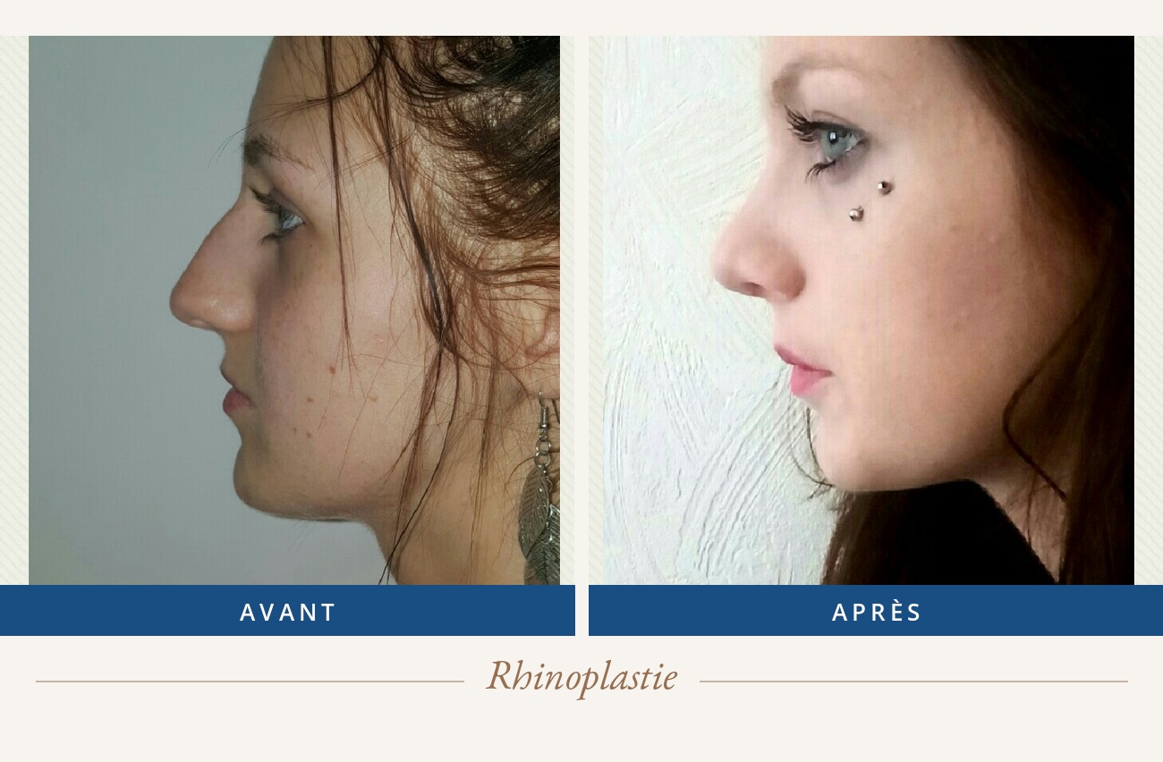 Résultat avant/après d'une rhinoplastie