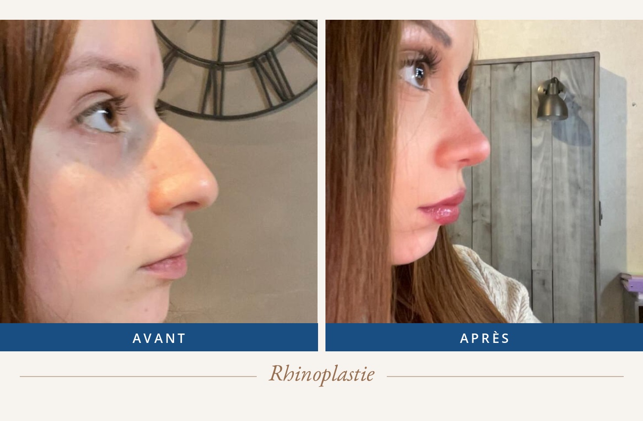 Résultat avant/après d'une rhinoplastie
